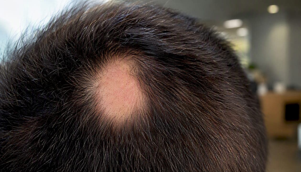Kreisrunder Haarausfall: Was hilft wirklich?