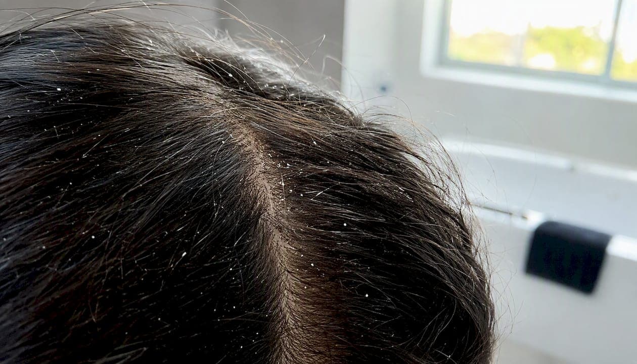 Schuppen und ihre Wirkung auf das Haar: Was wirklich zählt