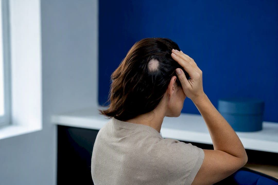 Alopecia areata: cuándo actuar (si afecta más del 20 %)