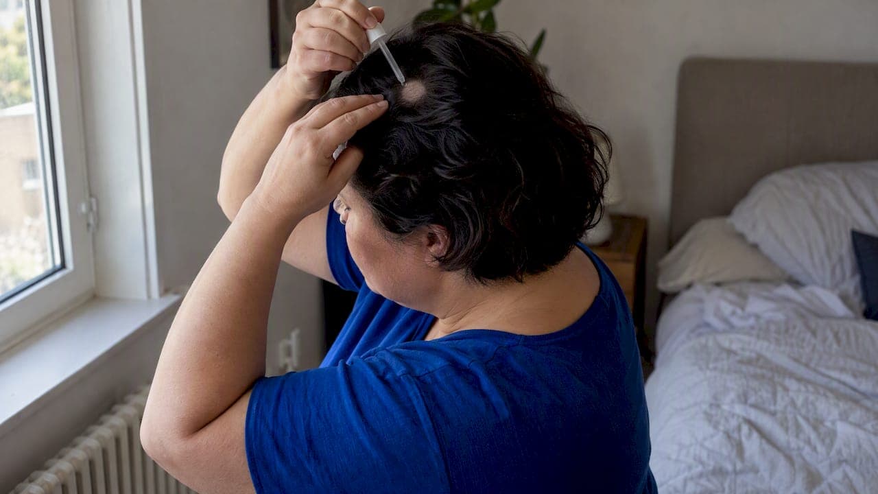 Mittel gegen kreisrunden Haarausfall: Was wirklich wirkt